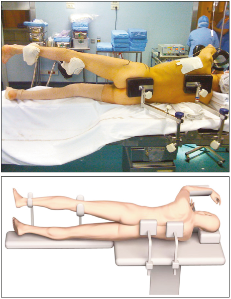 Points techniques dans l’arthroplastie de hanche par voie antero-laterale mini-invasive selon Rottinger