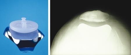 La prothèse fémoro-patellaire anatomique - Cahier des charges et technique