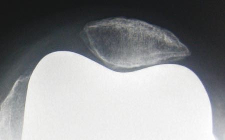 La congruence fémoro patellaire dans les prothèses du genou