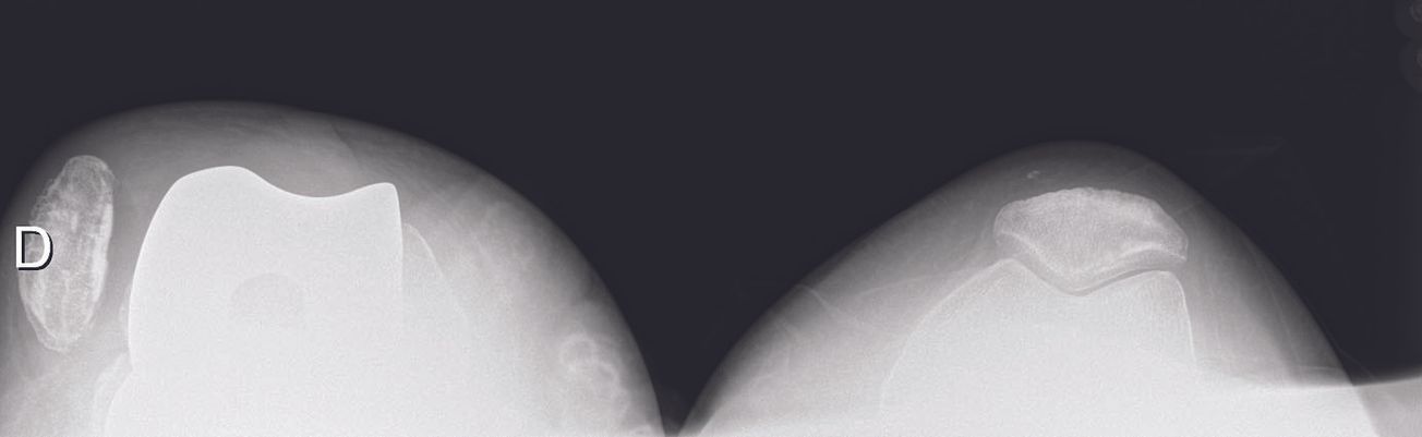 Y a-t-il une place pour la reconstruction du MPFL sur prothèse totale du genou ?