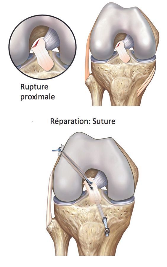Suture du ligament croisé antérieur dans les avulsions proximales fraiches