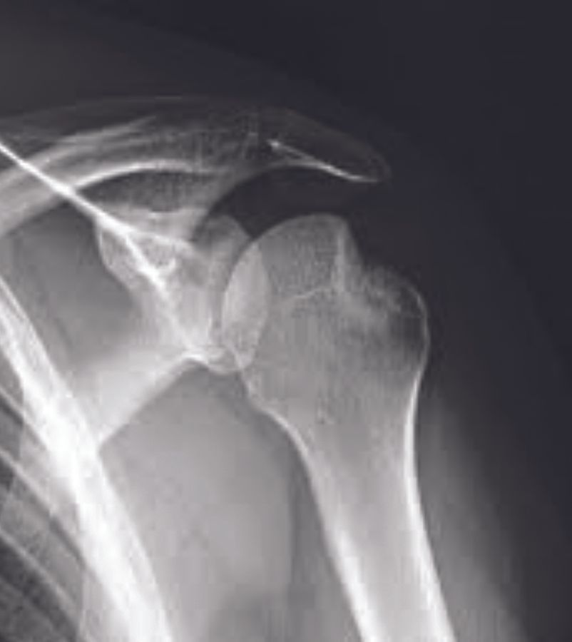 Y a-t-il encore des indications à combler les encoches de Malgaigne sous arthroscopie ?