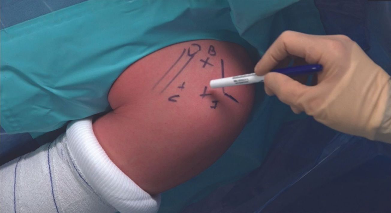 Le bankart augmenté