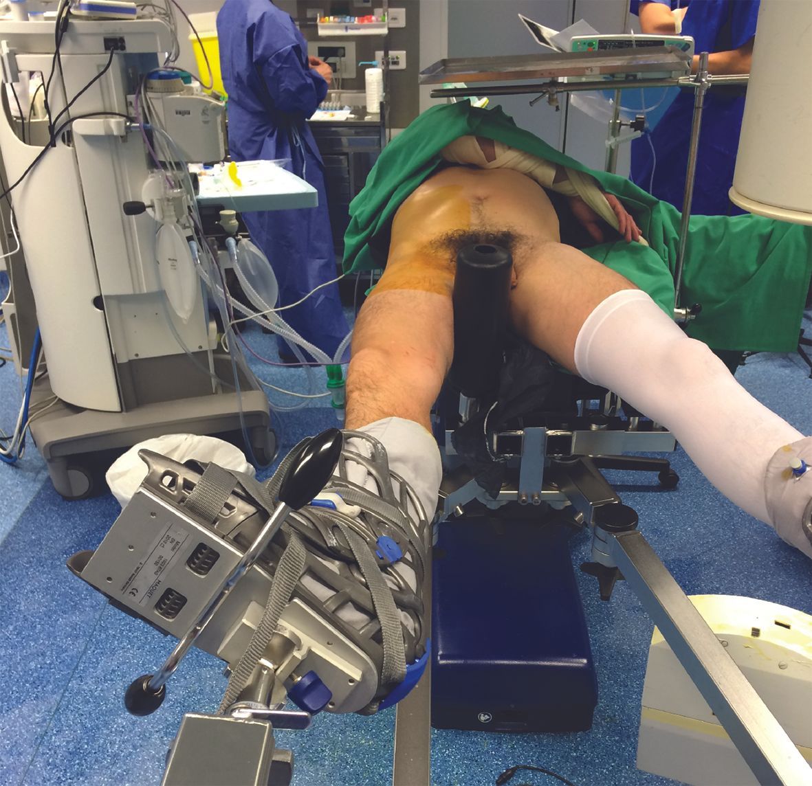 Technique endoscopique de la ténotomie ilio-psoas  à hauteur du petit trochanter  dans le conflit psoas-cupule prothétique