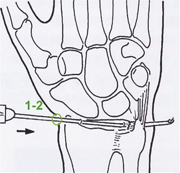 Réinsertion Périfovéale du TFCC  sous arthroscopie : Expérience hong-kongaise