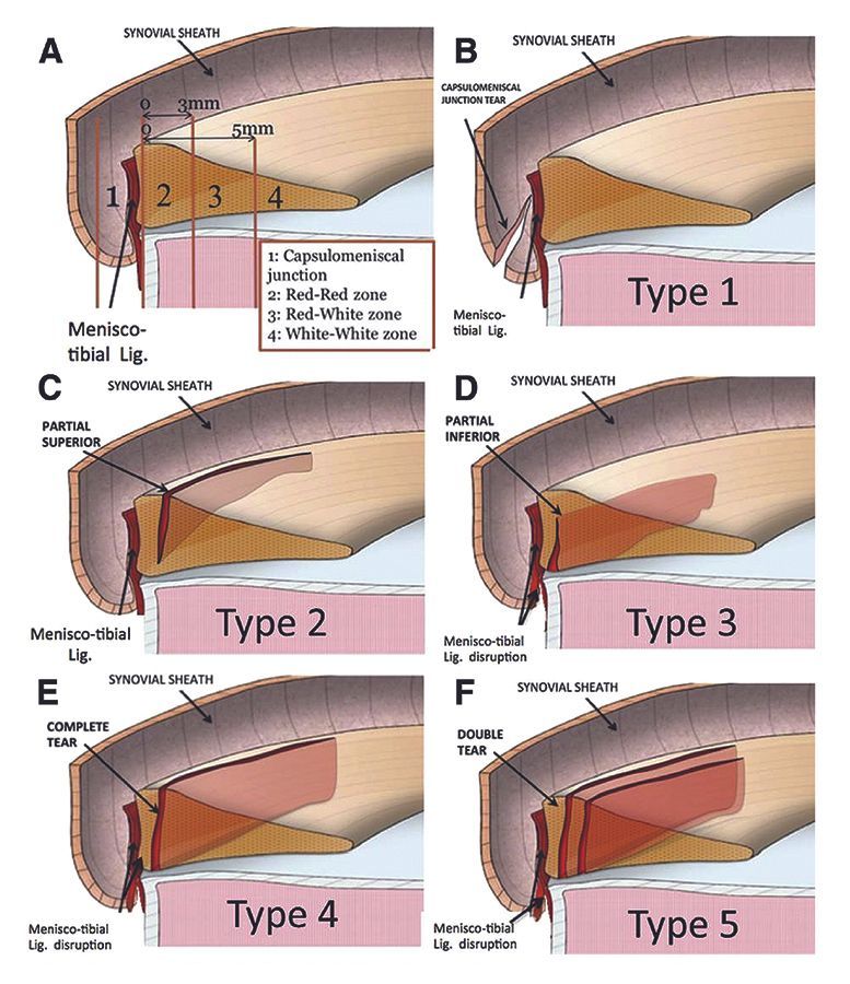 Traitement à la carte dans la lésion du LCA : Et les stabilisateurs secondaires ?