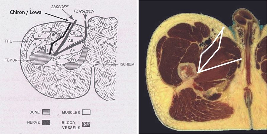 La voie antéro médiale de la hanche chez l'adulte