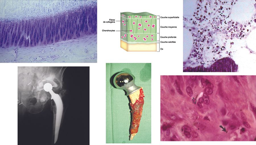 Anatomie et prothèse totale de hanche