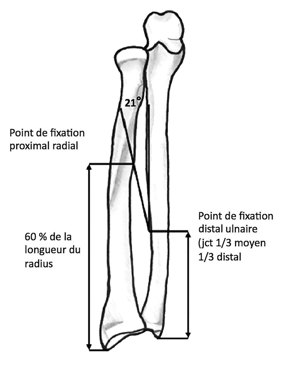 L’instabilité longitudinale du cadre antébrachial : Syndrome d’Essex-Lopresti.