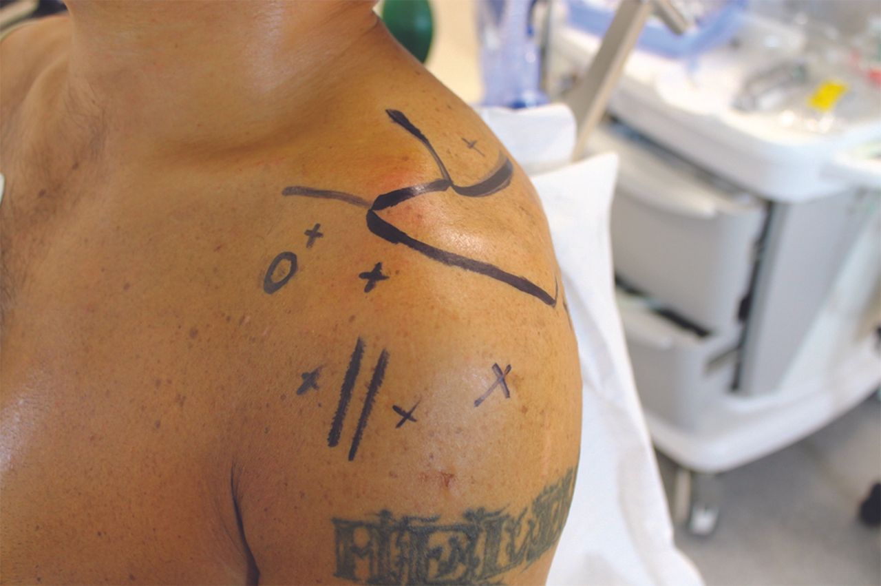 Technique de ténodèse du biceps sous la coulisse bicipitale