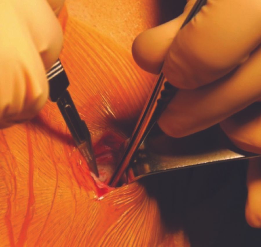 Technique chirurgicale de la ligamentoplastie  du LCA intra et extra articulaire  aux tendons ischio-jambiers