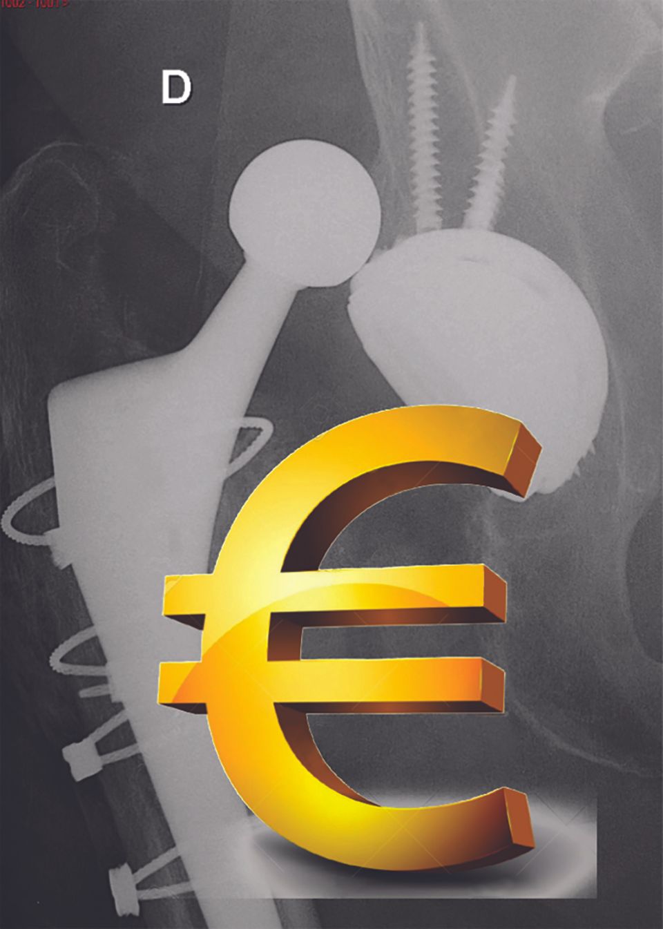 Coût économique en France de l’instabilité des Prothèses de Hanche