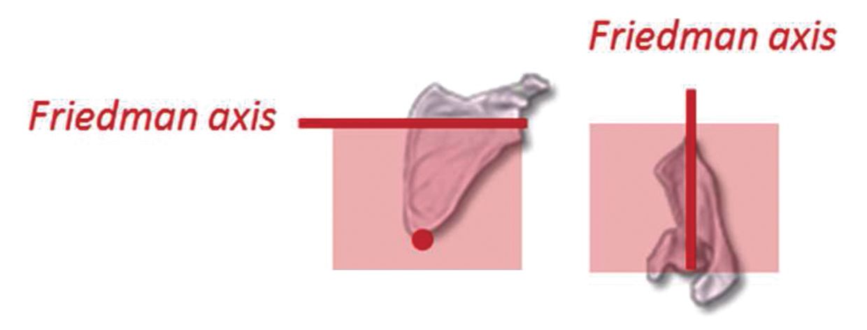 Planification et Navigation des Prothèses Totales d’Epaule
