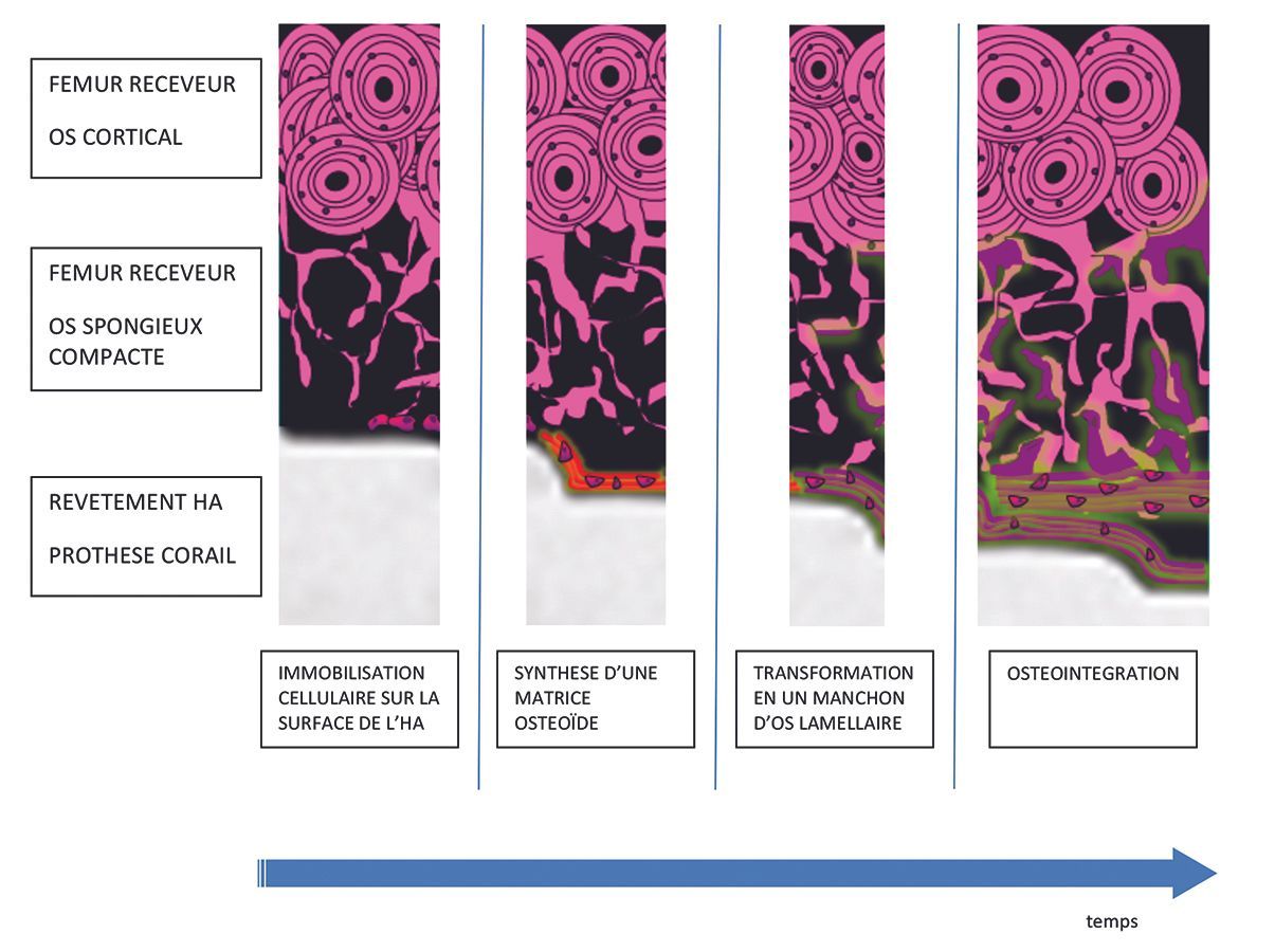 Performance du revêtement d'hydroxyapatite de la prothèse corail : un équilibre gagnant