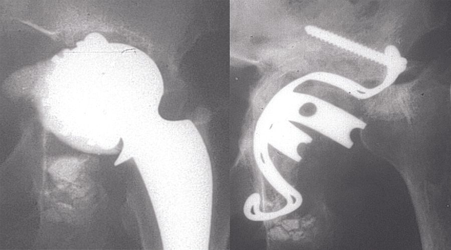 Technique de Reconstruction Cotyloïdienne  par armature de Kerboull et allogreffe