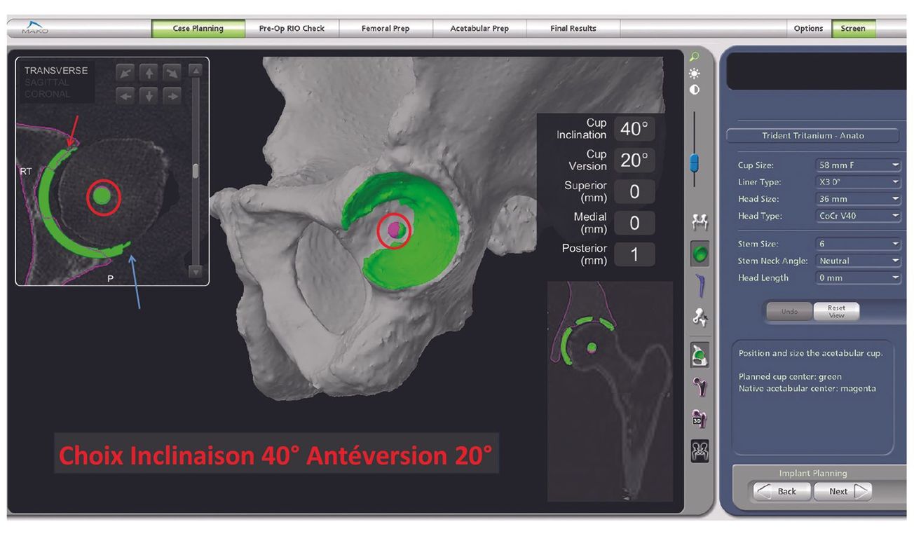 Prothèse totale de hanche assistée par robot : de la planification à la robotisation