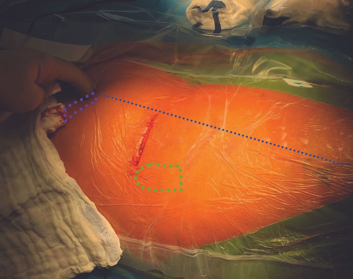 Bikini et voie de Hueter