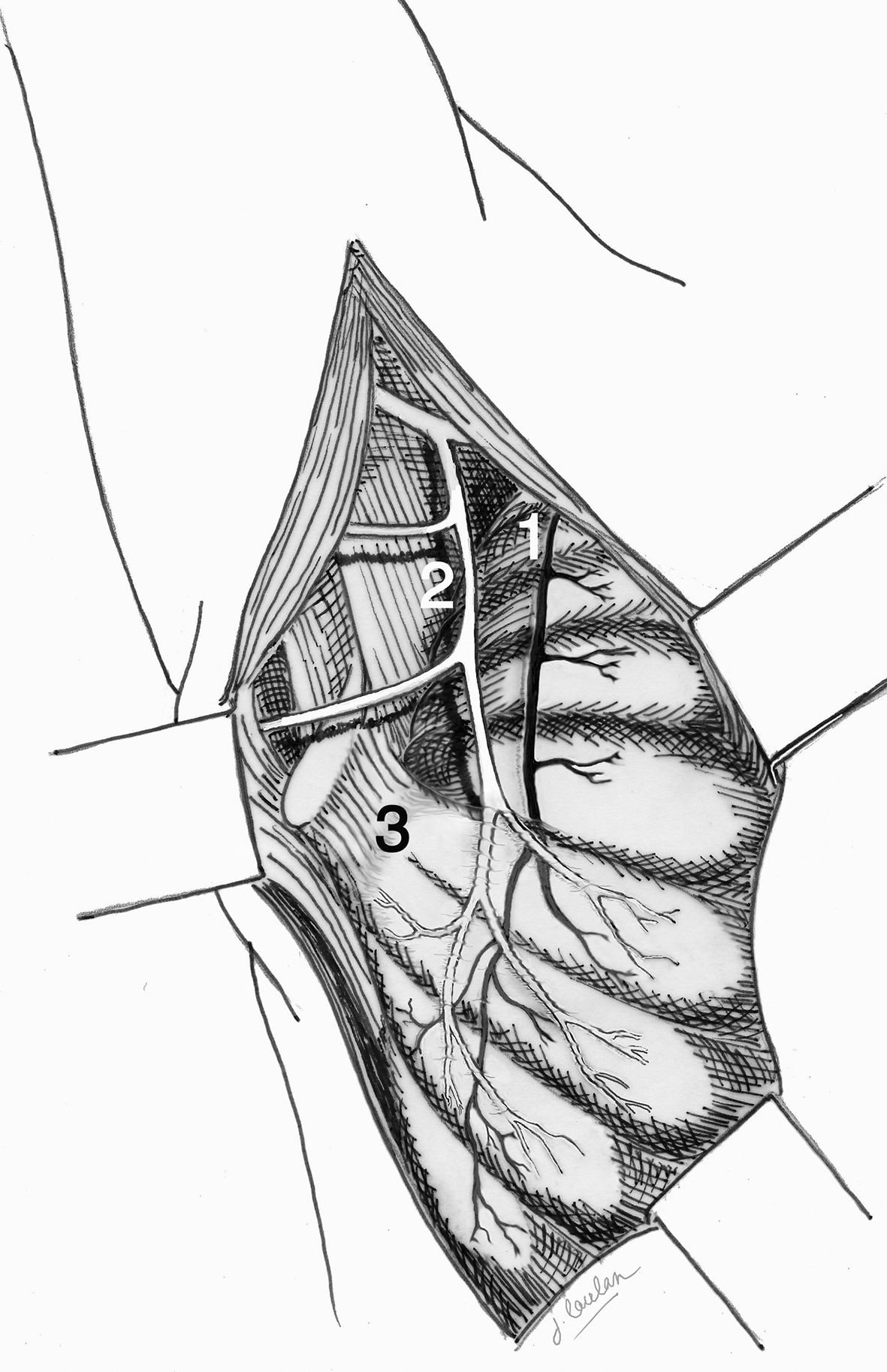 Mononeuropathie mécanique du nerf thoracique long