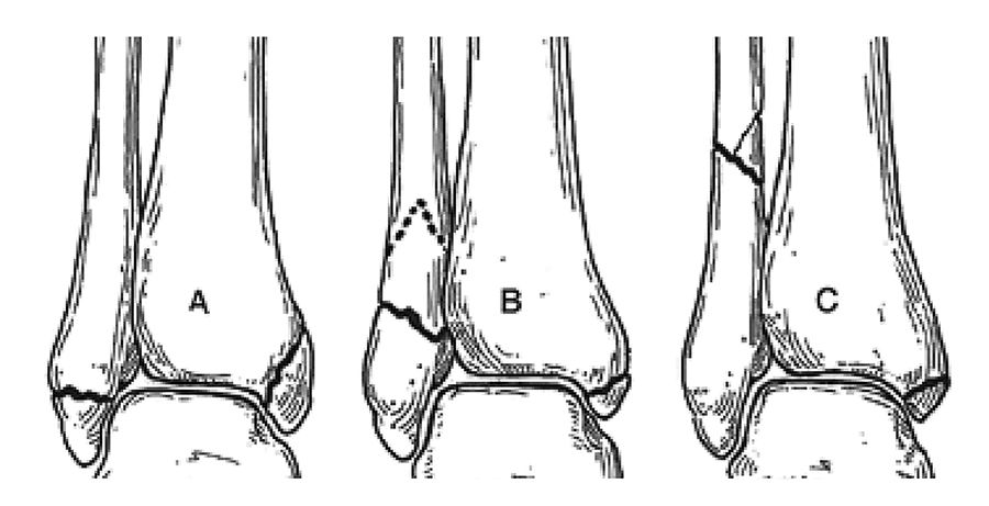 Reprise d'appui total après ostéosynthèse des fractures isolées de la malléole latérale par plaque verrouillée anatomique