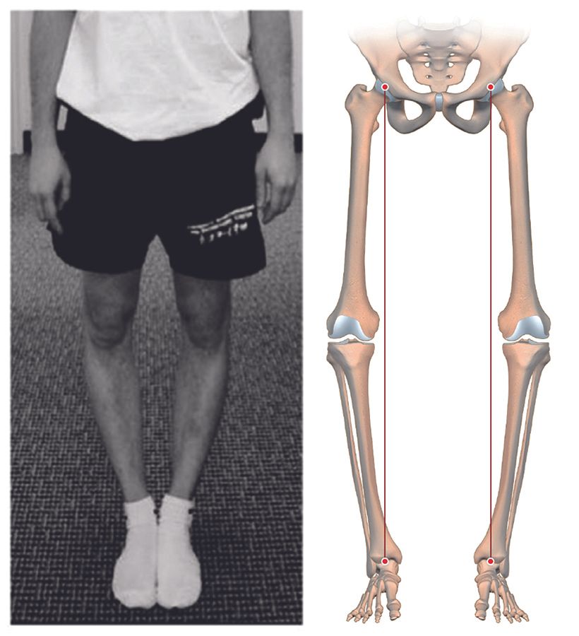 Quelles alternatives à l’alignement mécanique pour les prothèses totales de genou ? De l’alignement anatomique à l’alignement cinématique