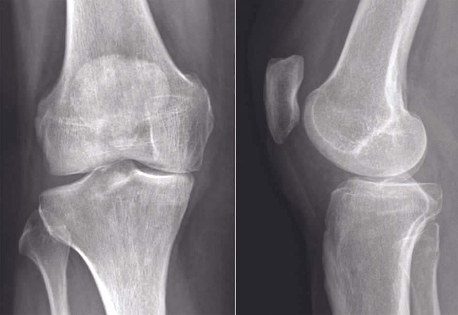 De la prothèse partielle à la prothèse totale du genou :  un voyage au pays de la chirurgie robotique