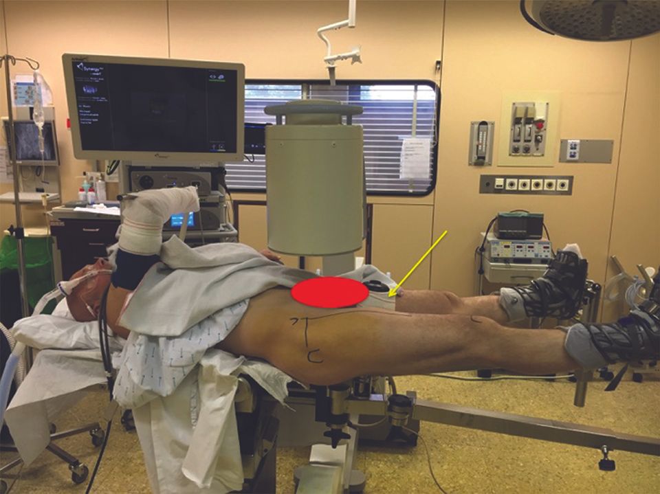 Arthroscopie de hanche sur table orthopédique : Technique, trucs et astuces pour éviter les complications potentielles