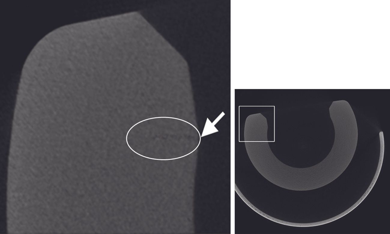 Les polyéthylènes hautement réticulés : une alternative innovante et fiable au polyéthylène conventionnel dans les cotyles à double mobilité ? Validation biomécanique et implications cliniques