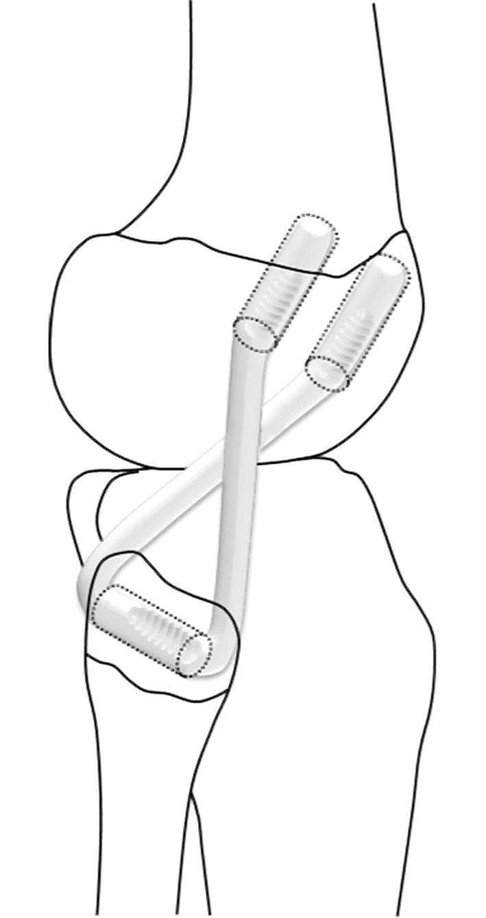 Reconstruction du point d’angle postéro-latéral du genou selon la technique chirurgicale du SORI : retour d’expérience australienne