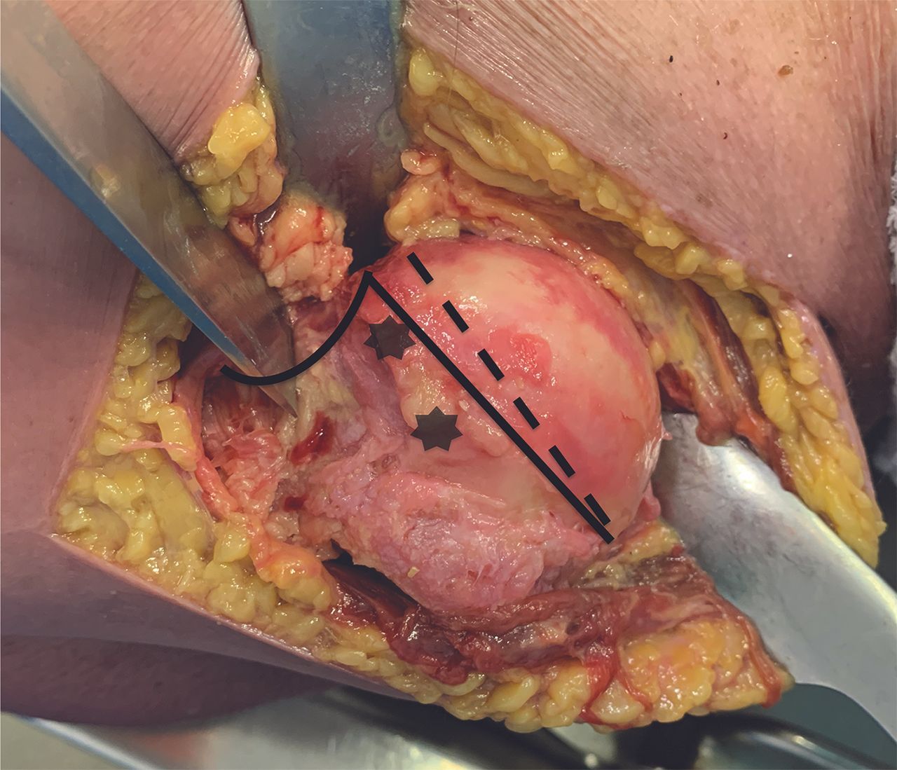 Prothèse totale anatomique d’épaule avec Implant Easytech : résultats et trucs techniques