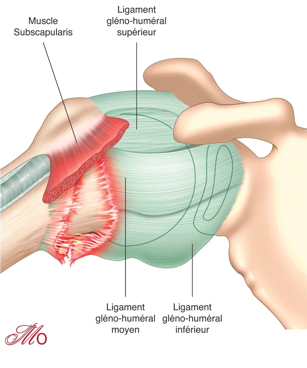 Avulsion humérale du ligament  gléno-huméral (HAGL)