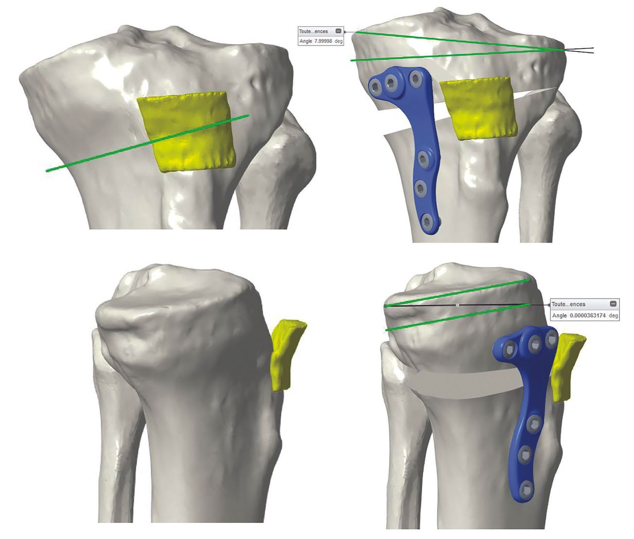 Guide de Coupe, de Correction et  de Positionnement d’implant « Patient’s Specific »  dans les Ostéotomies Tibiales de Valgisation