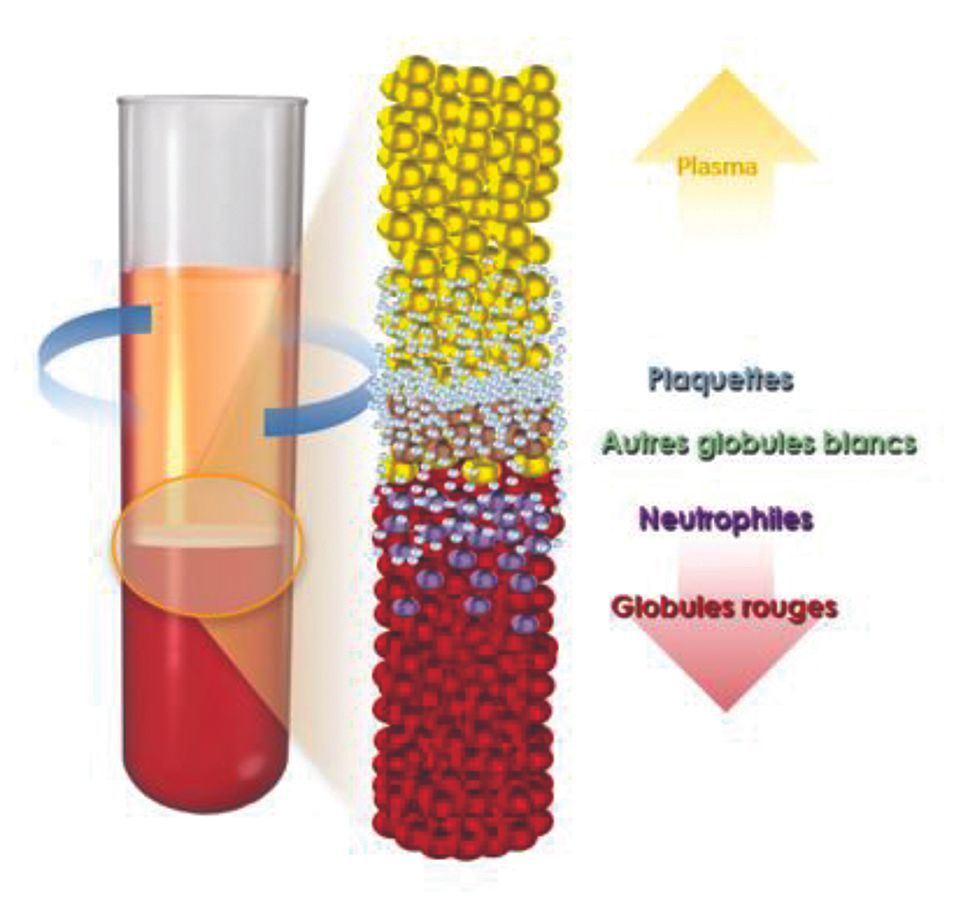 Plasma riche en plaquettes : expérience personnelle