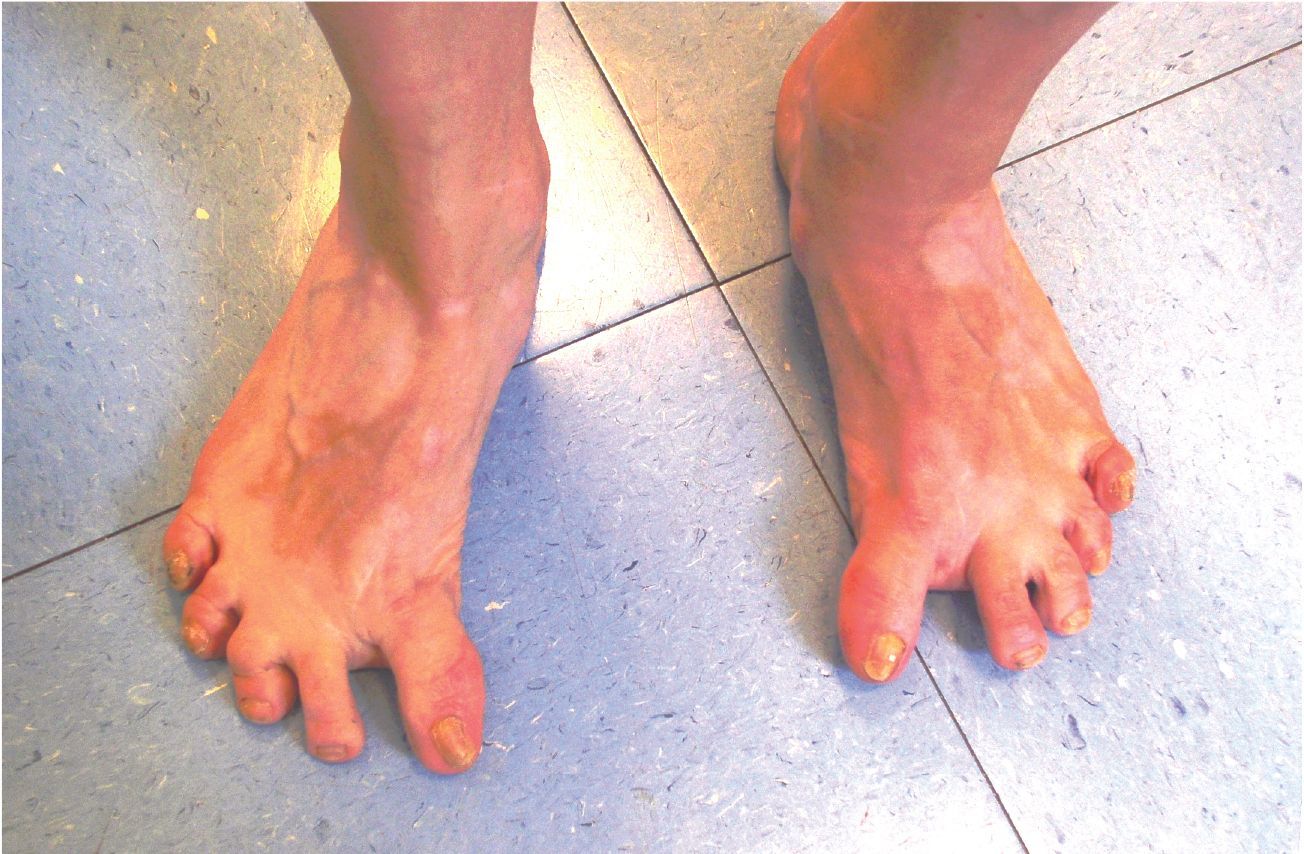 Traitement hallux varus post opératoire par ostéotomie scarf inversé