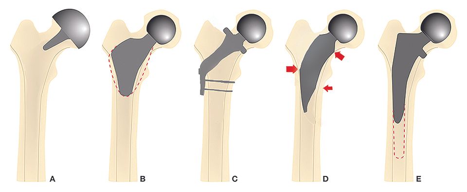 Les tiges fémorales courtes : le chaînon manquant ?