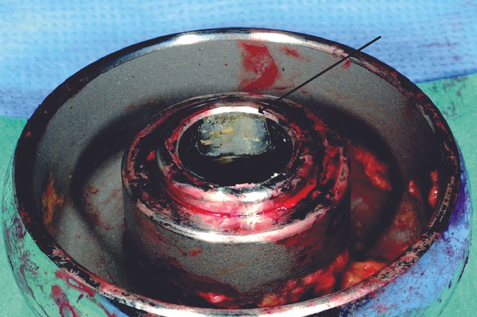 La trunnionite, quésaco ?