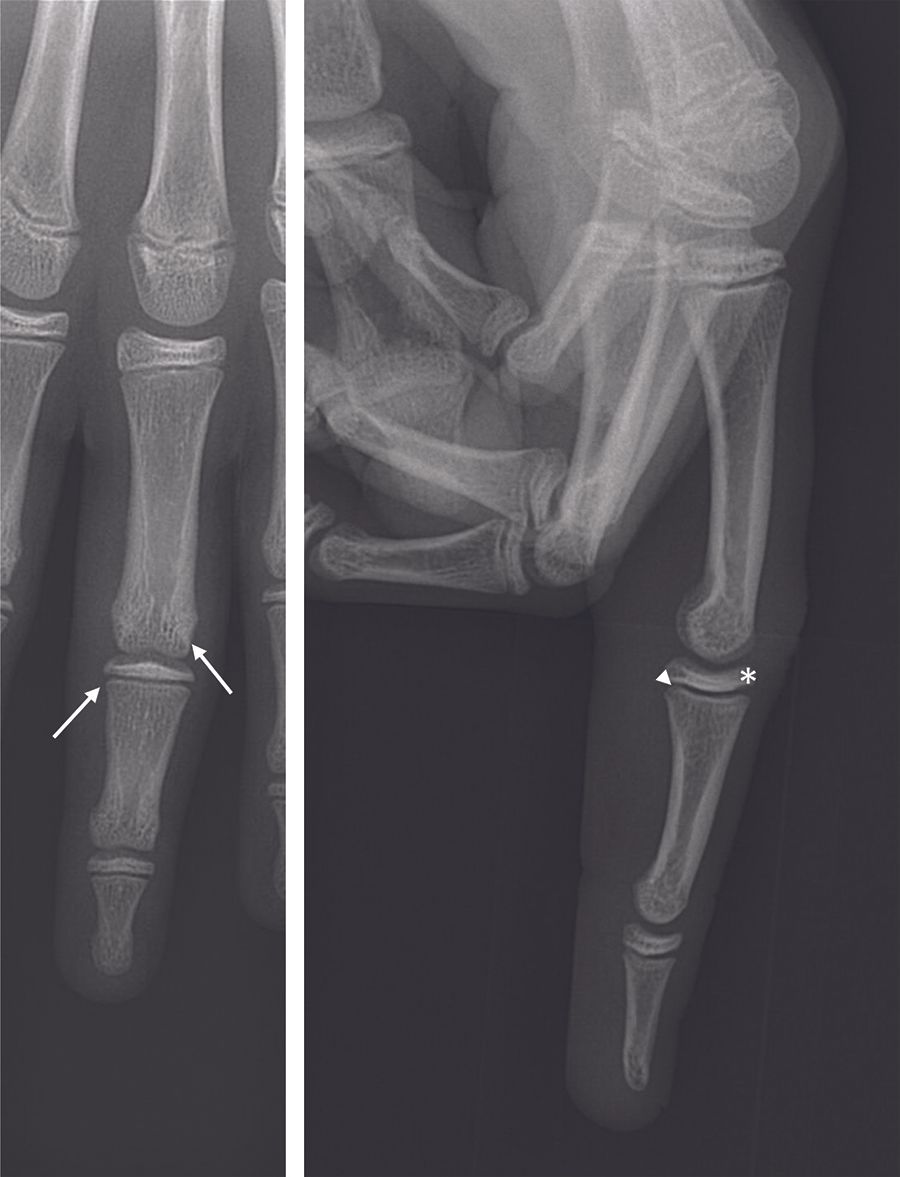 Traumatismes de l'articulation interphalangienne proximale des doigts longs en pédiatrie