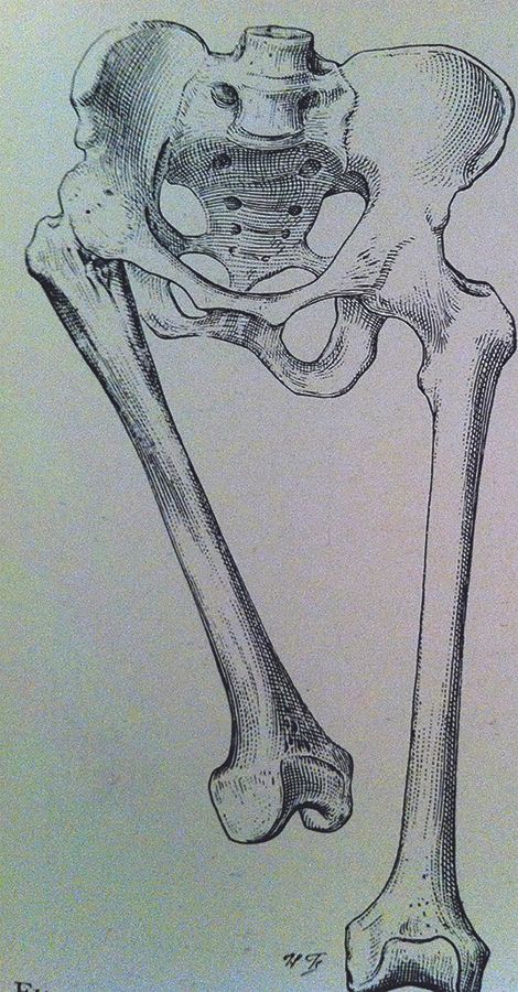 « De la coxalgie » son histoire