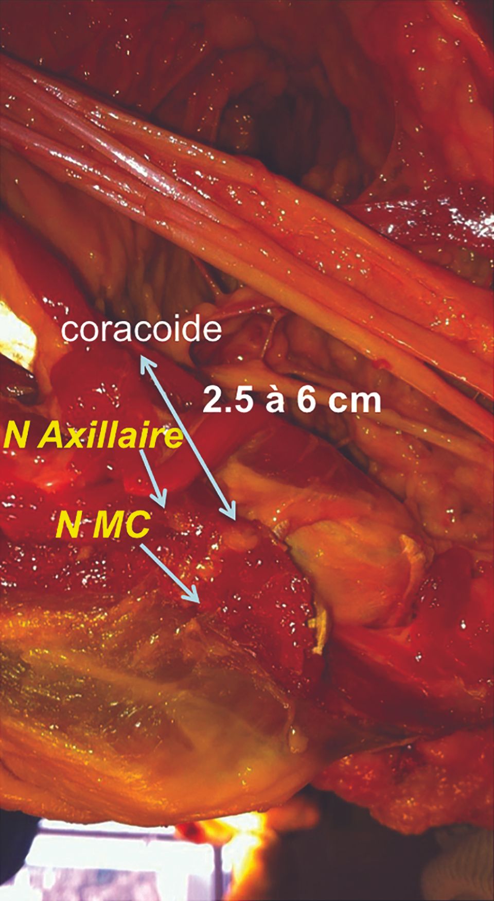Anatomie Chirurgicale des principaux nerfs à l’épaule : nerf axillaire, musculo-cutané et suprascapulaire