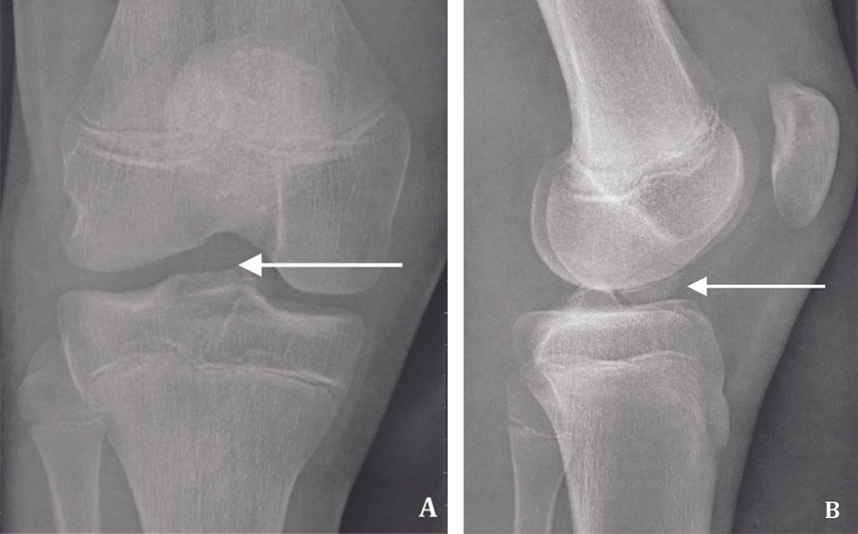 Traitement d’une fracture des épines tibiales par suture sur une ancre résorbable sous arthroscopie