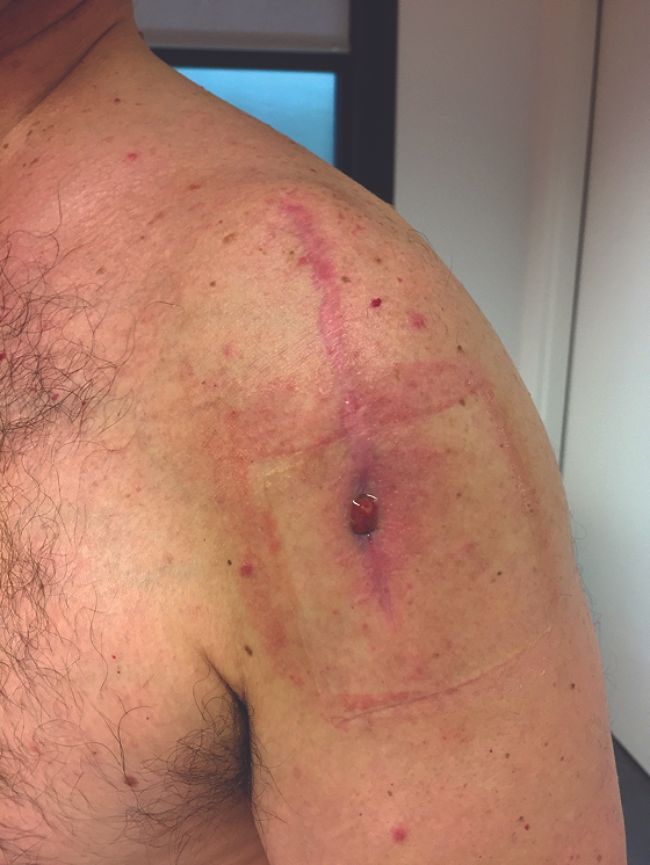 Prise en charge des prothèses d’épaule infectées