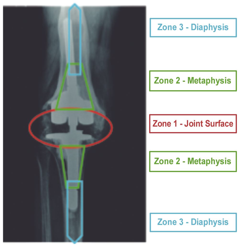 Retour d’expérience sur les reprises de prothèses totales de genou avec manchon métaphysaire