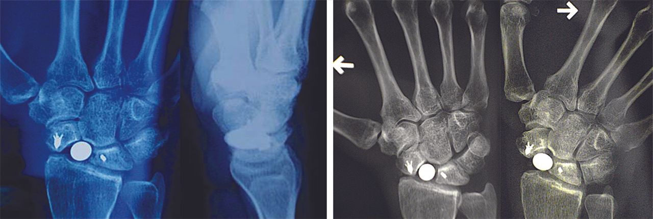 Les prothèses de la main et du poignet « Ensemble continuons à innover »