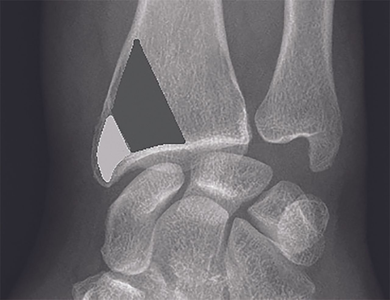 Luxations et fractures luxations radio-carpiennes : diagnostic et prise en charge chirurgicale