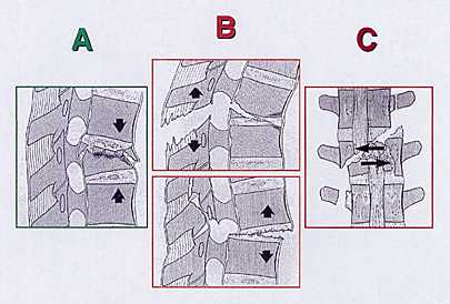 Comment nous traitons les fractures récentes du rachis thoraco-lombaire