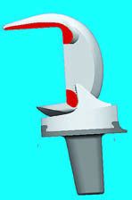 Luxation des PTG : un risque spécifique des prothèses à plateau mobile ?