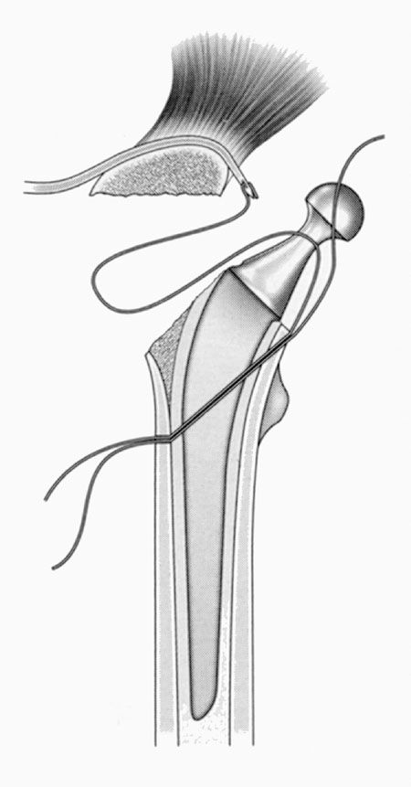 Traitement des pseudarthroses trochantériennes après arthroplastie totale de hanche