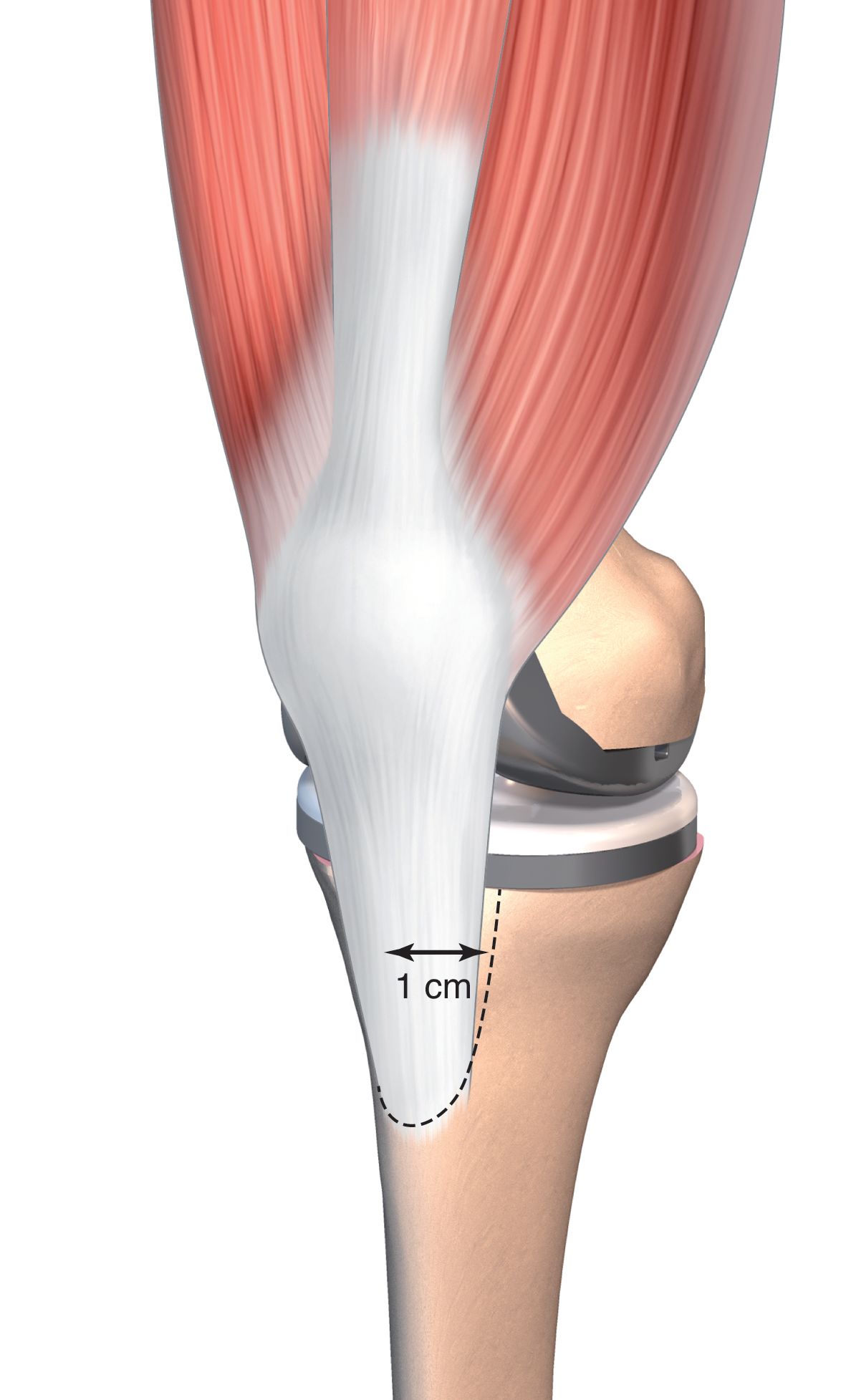 Ostéotomie de la tubérosité tibiale : modification de l'ostéotomie de la crête de la tubérosité (TCO) pour garantir une exposition aisément extensible et sûre du genou