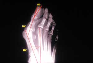 Technique de l'ostéotomie de la 1ère phalange du gros orteil dite en "sandwich" dans la cure chirurgicale de l'hallux valgus