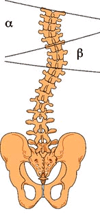 Comment nous opérons une scoliose de l'adolescent. La nouvelle technique CD Horizon.