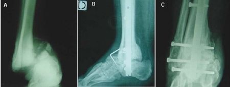 Comment je fais une arthrodèse tibio-talo-calcanéenne par clou rétrograde ?